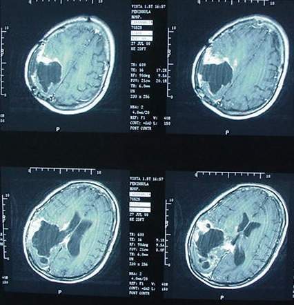 Augmentation de 50% des tumeurs du cerveau chez les enfants au Royaume-Uni en 10 ans + 40% au Danemark, en Finlande - explosion du phénomène en France - 30/05/2012 Augmentation de 50% des tumeurs du cerveau chez les enfants au Royaume-Uni en 10 ans + 40% au Danemark, en Finlande - explosion du phénomène en France - 30/05/2012