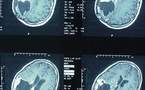 Augmentation de 40% des tumeurs cérébrales au Danemark de 2001 à 2010 - Registre du Cancer Danois - 16/12/2011